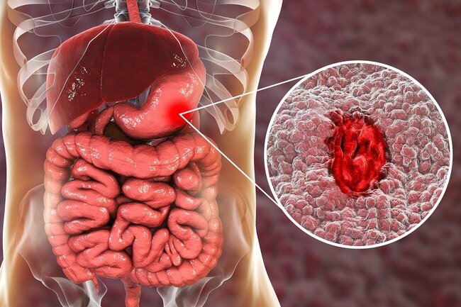 When your stomach's healthy, it's coated in a layer of sticky mucus.