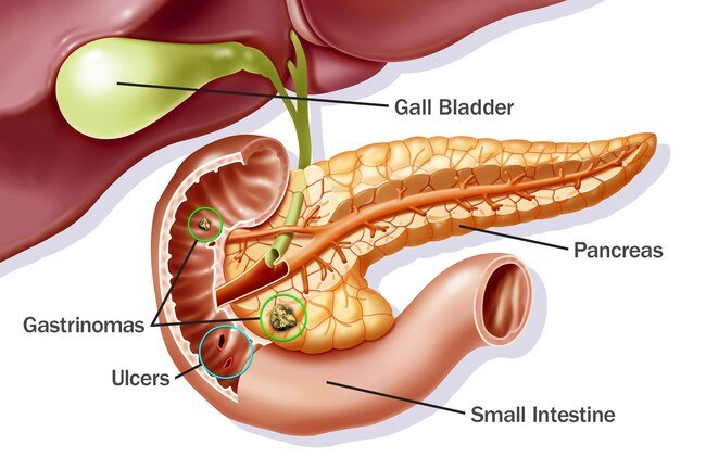 It's rare, but sometimes tumors cause stomach ulcers.