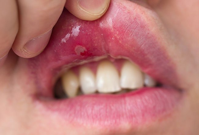 Stomatitis is inflammation of the mouth. It is painful and may be caused by infection, poor dental hygiene, nutritional deficiency, dehydration and other factors. 