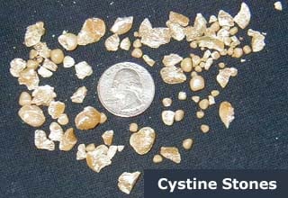 Cystine stones compared to quarter