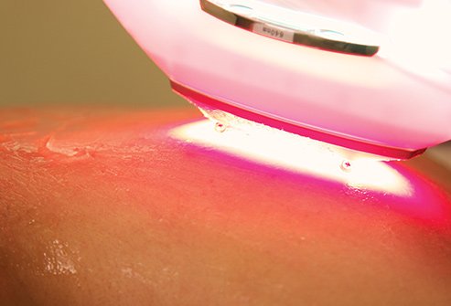 Laser treatments may help make stretch marks less noticeable.