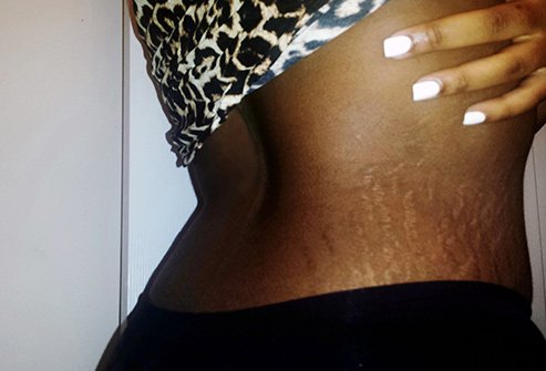 Stretch marks are most likely to appear on areas where your body stores fat including the thighs, hips, breast, belly, and buttocks.