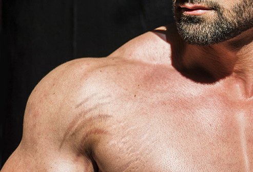 Rapid weight gain or increase in muscle mass may lead to stretch marks.