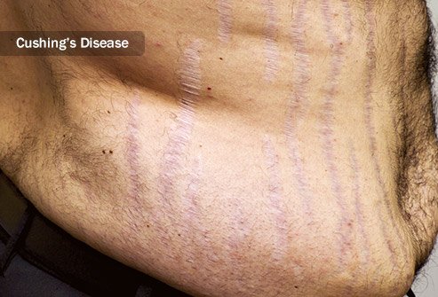 Conditions that affect hormone levels and connective tissue increase the chance of stretch marks.