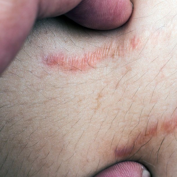 Stretch marks are linear streaks that appear on the skin due to the skin being overstretched. The lines at first are red and turn white over time.