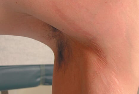 Picture of Stretch Marks: White Striae, Axilla.