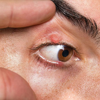 A man with styes on his upper and lower eyelids.