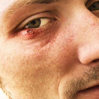Complications of a sty include cellulitis and conjunctivitis.