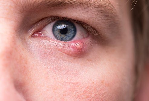 It is usually not possible to get rid of a stye completely overnight