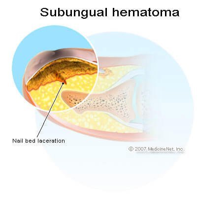 Picture of subungual hematoma