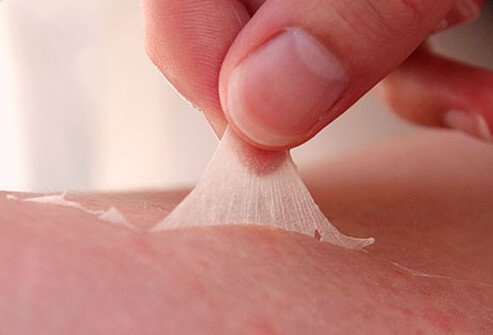Too much sun causes painful red sunburned skin that may peel.