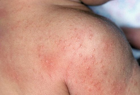 Heat rash results from blocked sweat ducts and produces small pinkish pimples.