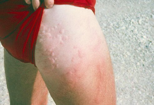 Jellyfish stings cause painful red rashes and welts to appear on the skin.