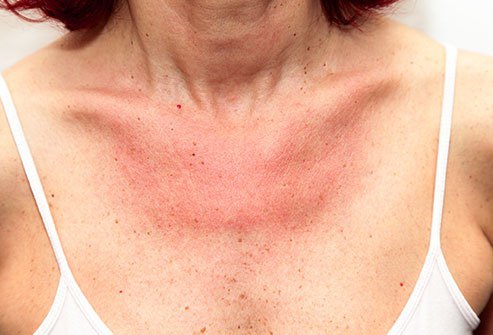 The most common cause for red spots is sunburn, but a condition called polymorphous light eruption (PLE) or heat rash might be to blame as well.