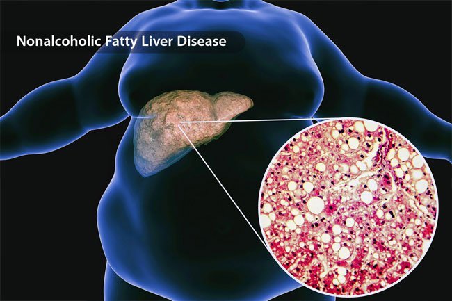 Nonalcoholic fatty liver disease can increase cholesterol levels.