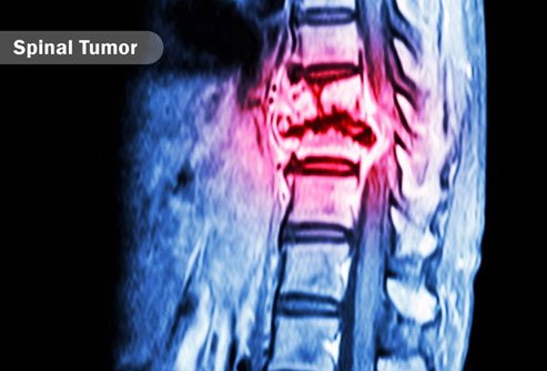 A tumor in the brain stem or spinal cord may lead to neuropathic itch.