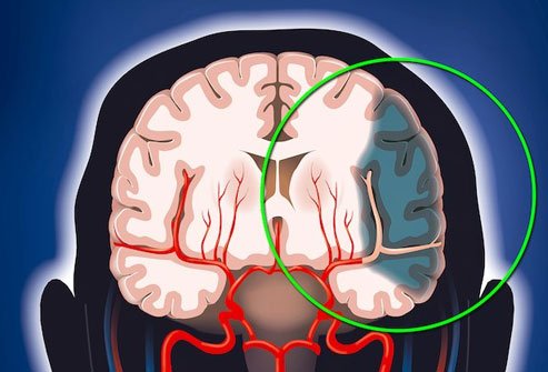 A stroke may produce itching if it affects a certain part of the brain or the trigeminal nerve.