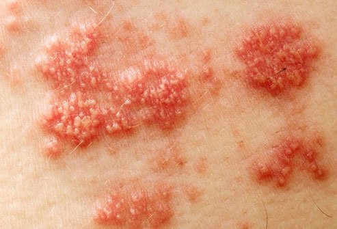 Itching commonly occurs when a person has shingles.