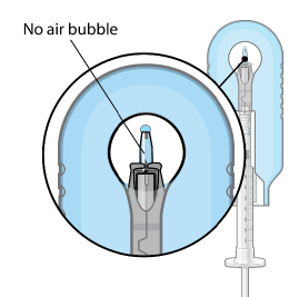 Proper appearance of implant after initial
filling with ranibizumab - Illustration