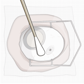 Stabilize the globe and orient the refill
needle - Illustration