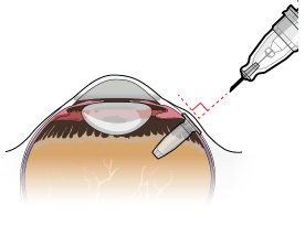 Orient the refill needle perpendicular to the globe - Illustration