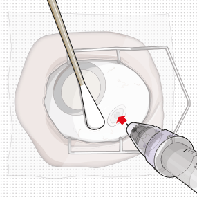 Targeting the center of the implant septum, insert the
refill needle perpendicularly through the conjunctiva and into the implant
septum - Illustration