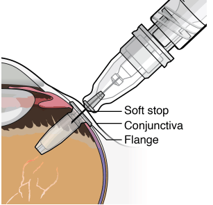 Continue inserting the needle until the soft stop of the
refill needle makes physical contact with the conjunctiva  - Illustration