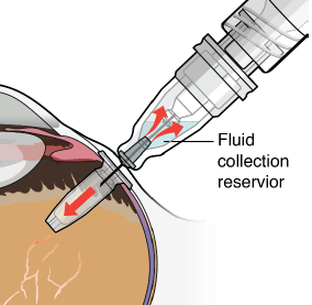  Refill the SUSVIMO Implant - Illustration