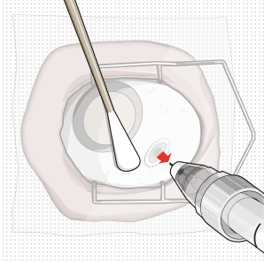 Withdraw the Syringe - Illustration