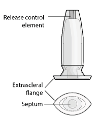 SUSVIMO implant - Illustration