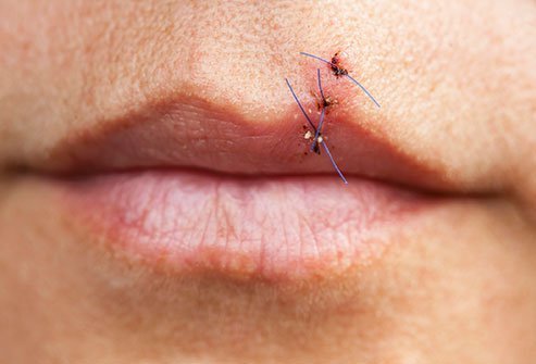 Lip lacerations may need sutures because they tend to scar. 