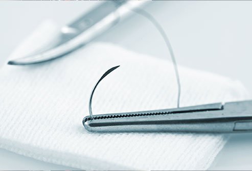 To obtain the desired outcome, it is essential to have good quality instruments depending on the nature of the wound.