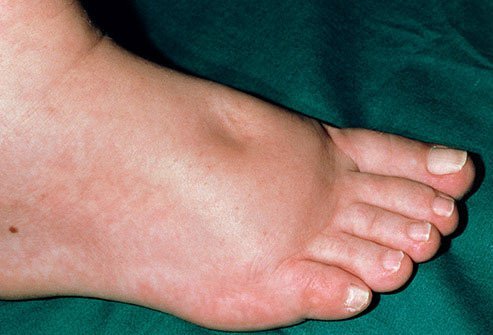 Edema is the official term for fluid retention.