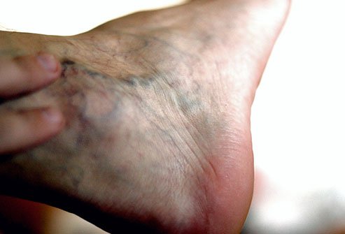 Chronic venous insufficiency causes swelling in the legs and feet.