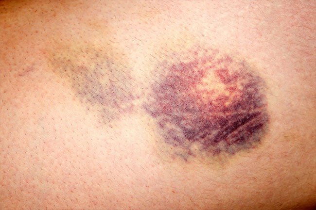 If your liver is failing, you may notice you get bruises more easily.