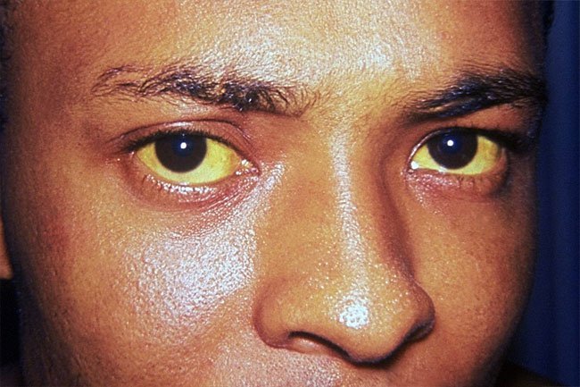 A damaged liver cannot clear the bilirubin out causing jaundice.