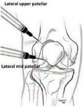 Using a lateral upper patellar or lateral mid patellar approach, place needle into the joint - Illustration