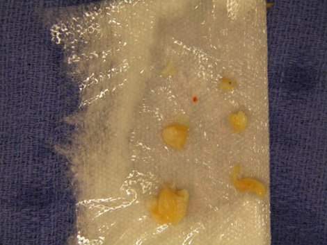 Photos of joint lining tissue resected from author's right third metacarpophalangeal joint