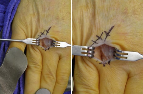 Intraoperative photos of the author's right third metacarpophalangeal joint
