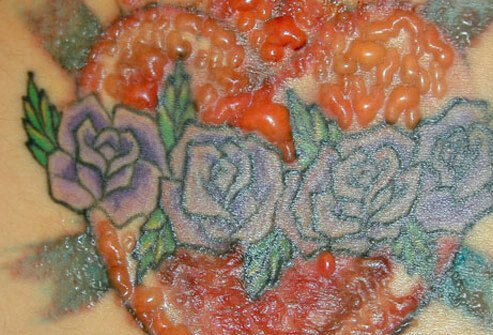 Exuberant blister in red tattoo pigment.