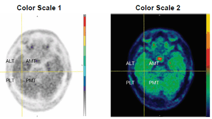 Temporal Lobe Quadrants - Illustration