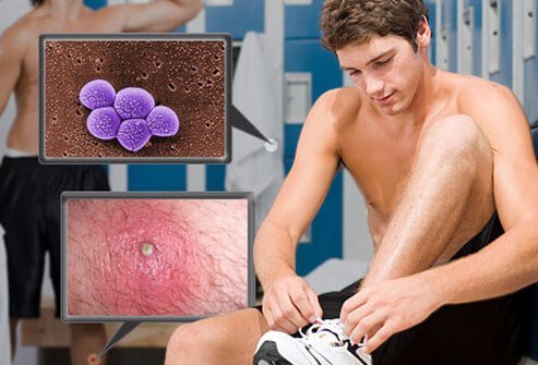 Photo of MRSA collage.