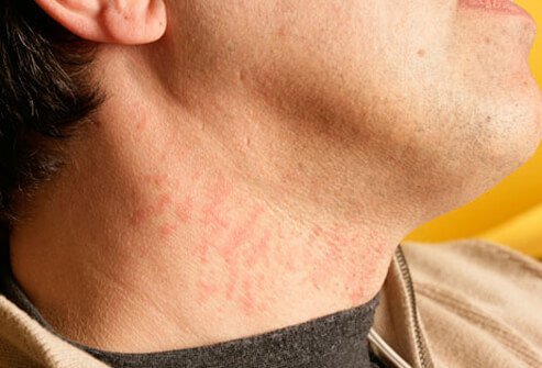 Photo of razor burn.