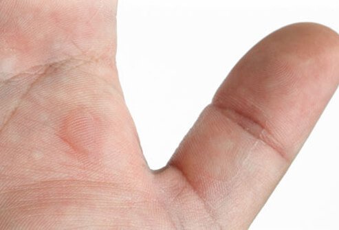 Photo of blister on hand.