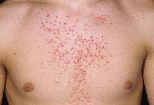 Photo of steroid acne.