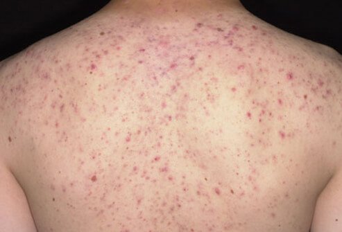 Photo of back acne.