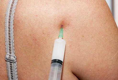 If it still hurts a week after a flare-up starts, your doctor may suggest corticosteroid shots.