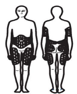 Injection Sites - Illustration