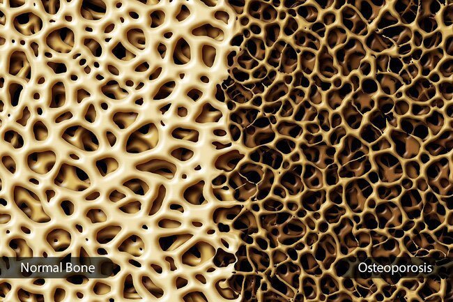 People with more belly fat have low bone density, a warning sign of osteoporosis.