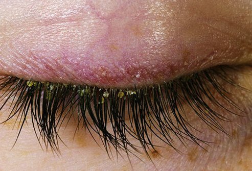 This condition can produce an itchy, scaling red rash on the scalp, in the ears, on the upper eyelids, brows, forehead.